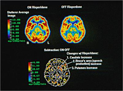 Investigation of Risperidone Treatment Associated With Enhanced Brain Activity in Patients Who Stutter